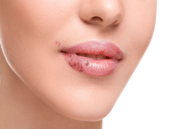 How To Hide A Cold Sore - Boldsky.com
