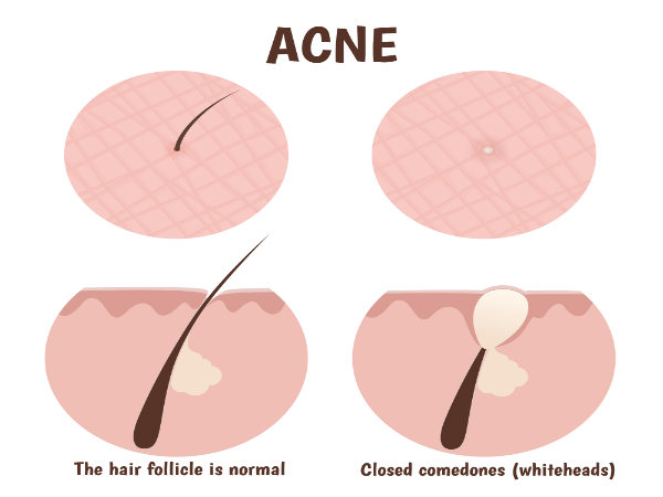 Tips To Get Rid of Whiteheads Faster
