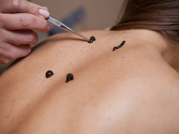 how is leech therapy beneficial boldsky com