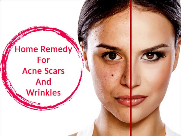 home remedy for acne scars and wrinkles natural cure for acne and