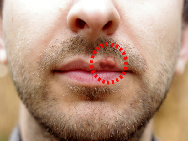 Ayurvedic Remedies For Herpes Boldsky Com