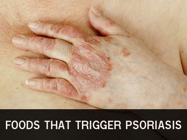 Foods That Trigger Psoriasis - Boldsky.com