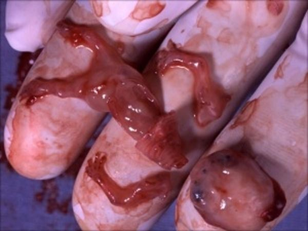 Disturbing Facts Of Babies That Survive An Abortion