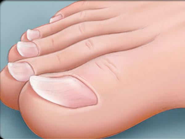 6 Dangerous Reasons Why Your Toe Nails Are Getting Darker Boldsky 1 Repeive Trauma