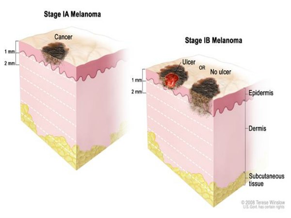 The Complete Guide to Melanoma Symptoms, Causes, and Cure