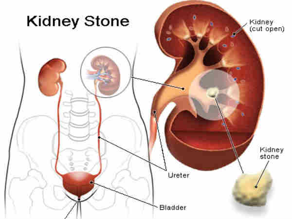 Kidney Stone Natural Treatment Kidney Stone Natural Treatment