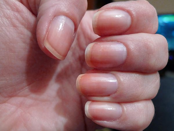 remedies for yellow nails remedies for yellow nails