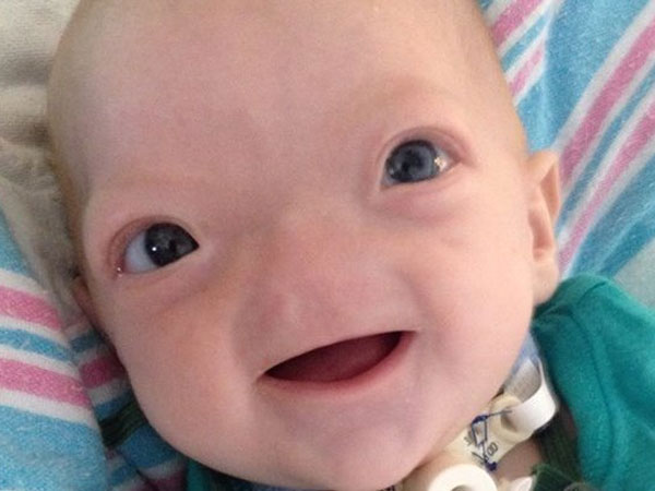 Real Life Story Of The Boy Who Was Born Without Nose Boldsky Com Real Life Story Of The Boy Who Was Born Without Nose Boldsky Com