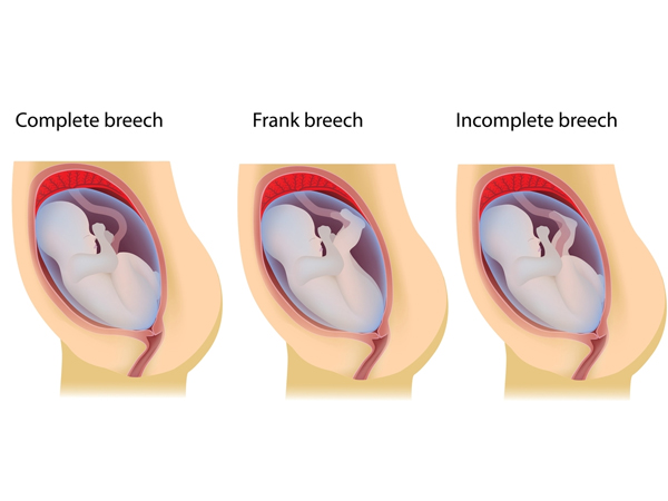 cephalic presentation risk