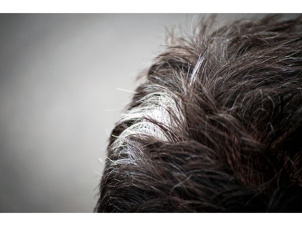 Poliosis (White Hair Patch): Symptoms, Causes And Treatment ...