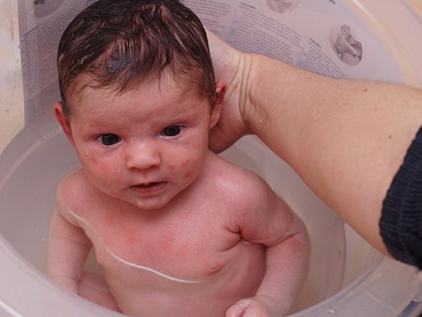How To Deal With Cradle Cap In Babies Boldsky Com