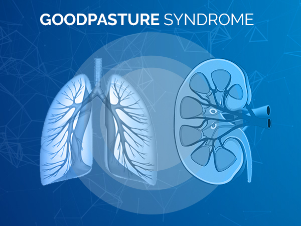 Goodpasture Syndrome Gps Causes Symptoms Diagnosis And Treatment Boldsky Com