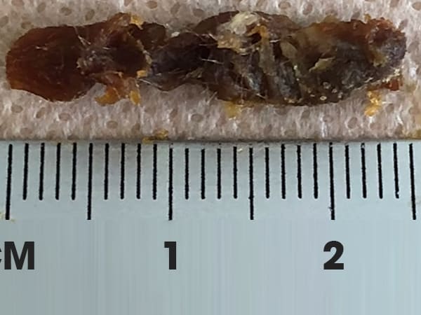 The doctor removed the biggest clump of earwax from the patient’s ear