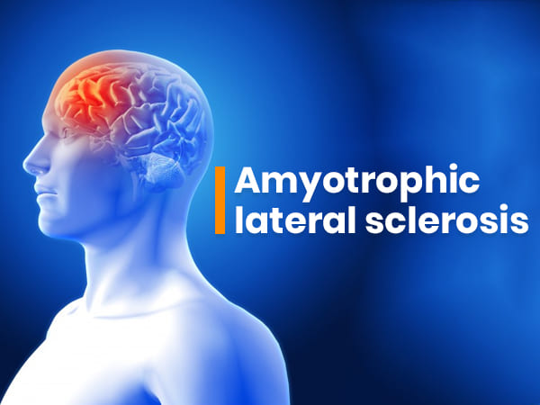 Amyotrophic Lateral Sclerosis Pictures amyotrophic-lateral-sclerosis-pictures
