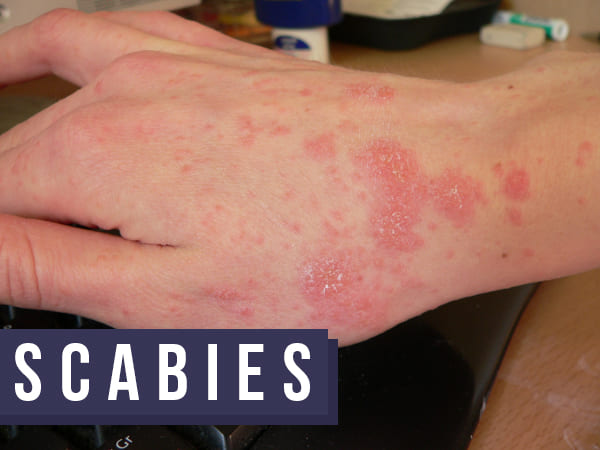 Scabies: Causes, Transmission, Symptoms, Diagnosis, Treatment And