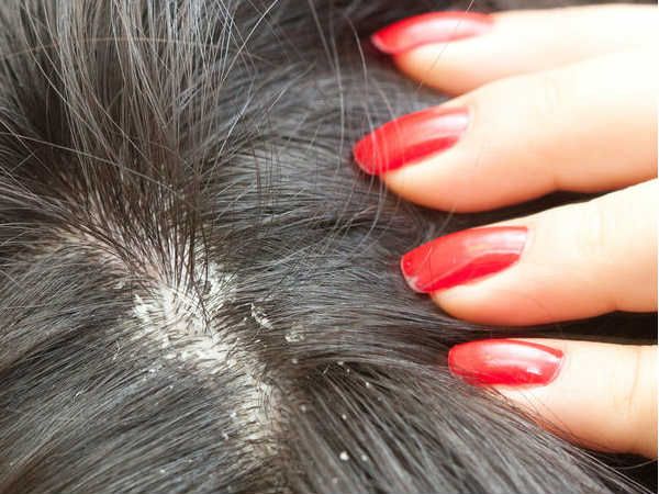 Itchy Scalp Scalp Pruritus Causes Symptoms Diagnosis Treatment