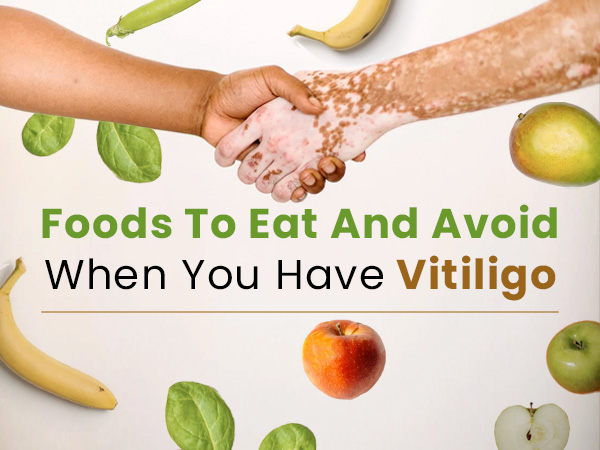 world-vitiligo-day-2021-list-of-foods-which-people-with-vitiligo