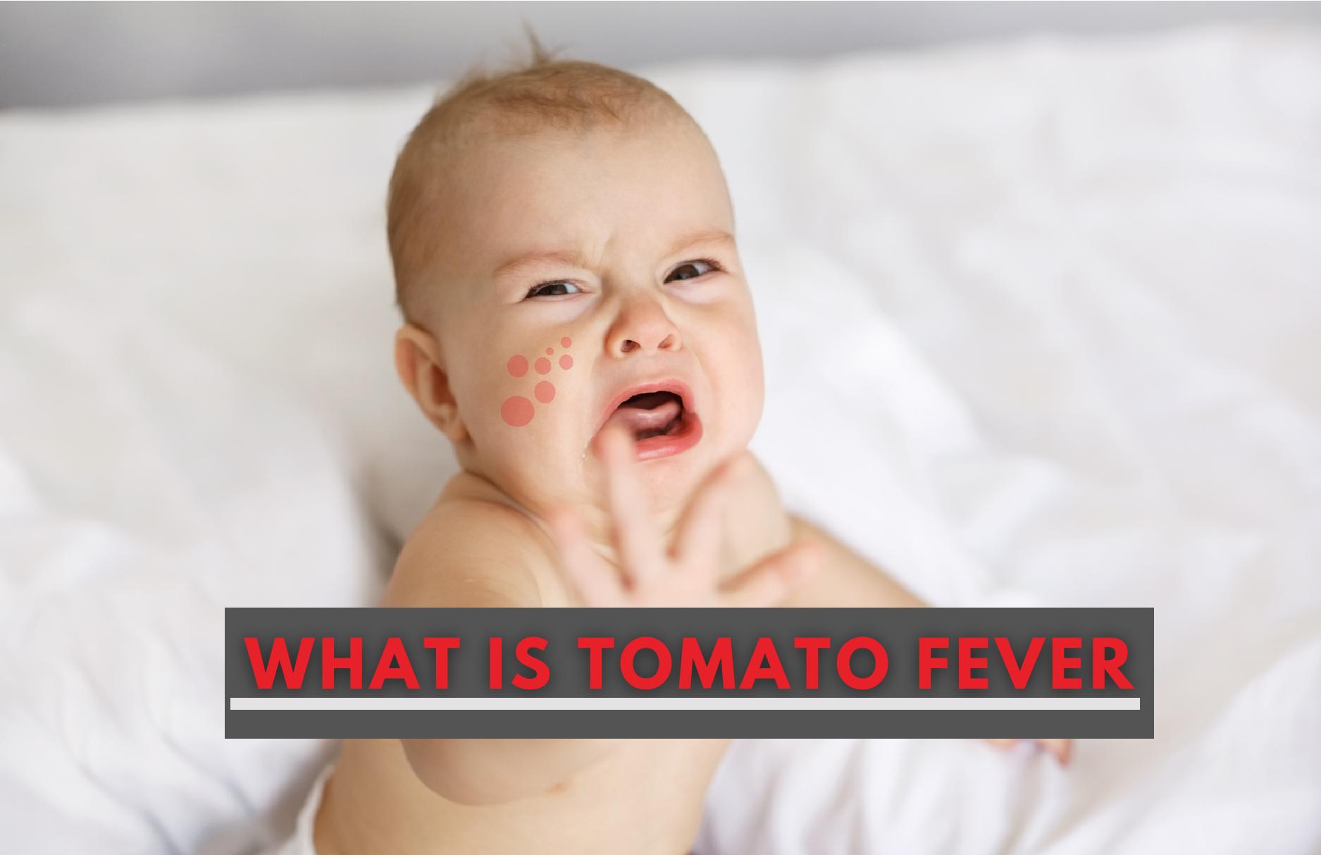 What Is Tomato Fever (Tomato Flu) Know Causes, Symptoms, Treatment And