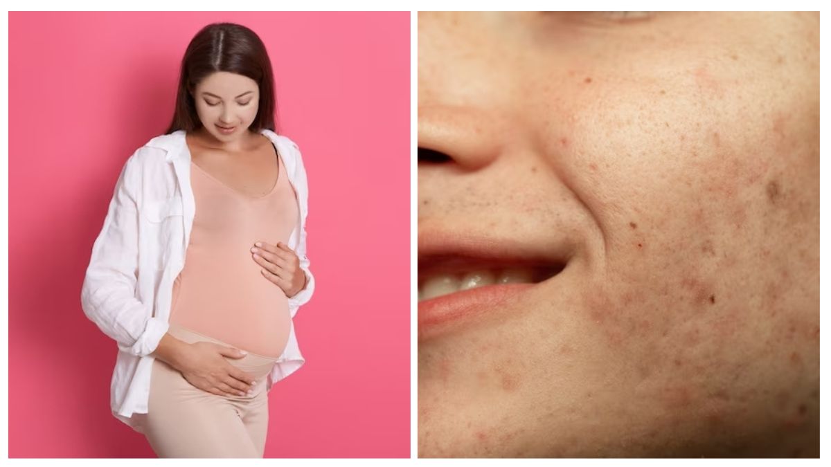What Is Pregnancy Mask (Melasma) Ways To Manage It