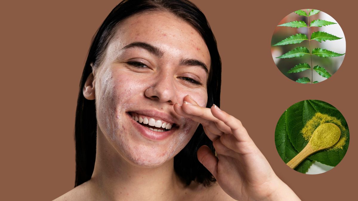 Treat Acne With Neem Try These 3 East AtHome Methods