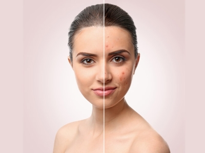 rice water toner for acne