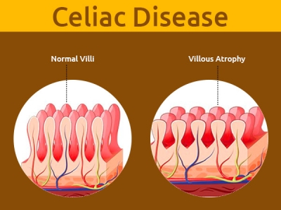 What Is Celiac Disease?