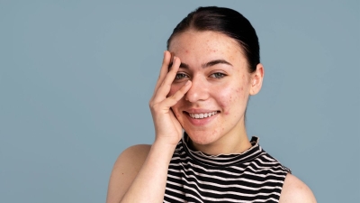Makeup Tips For Acne-Prone Skin